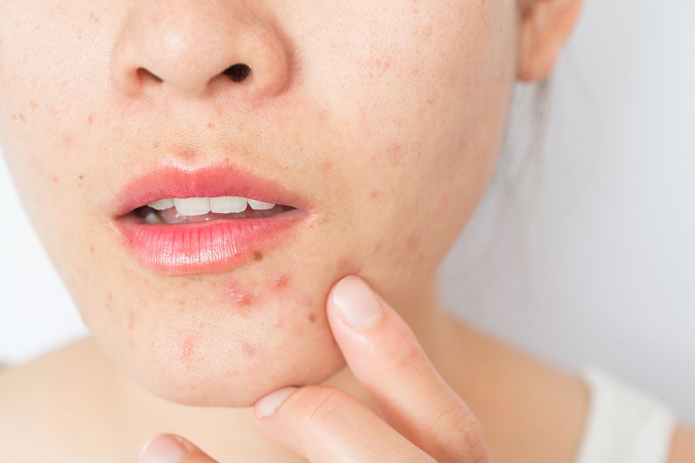 closeup of woman half face with problems of acne inflammation papule and pustule on her face