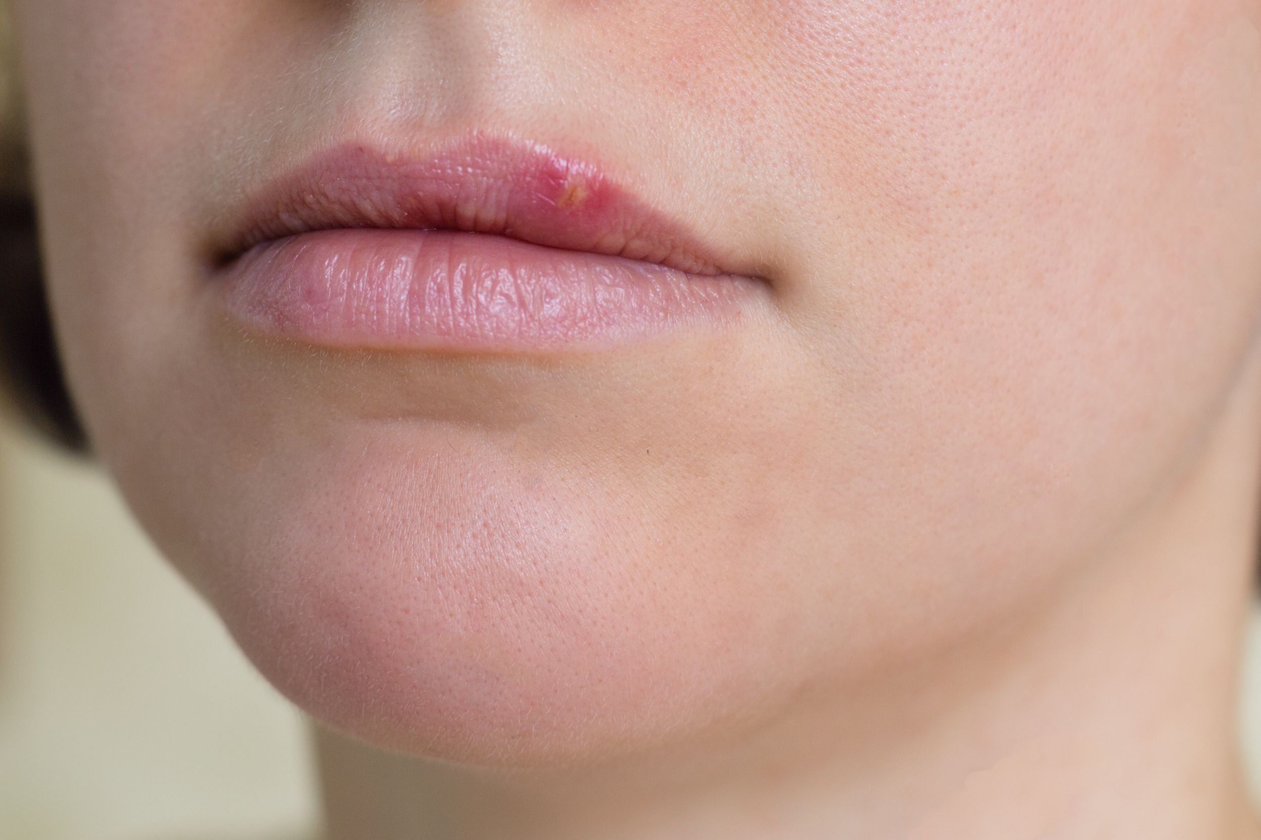 Cold Sores On Lips