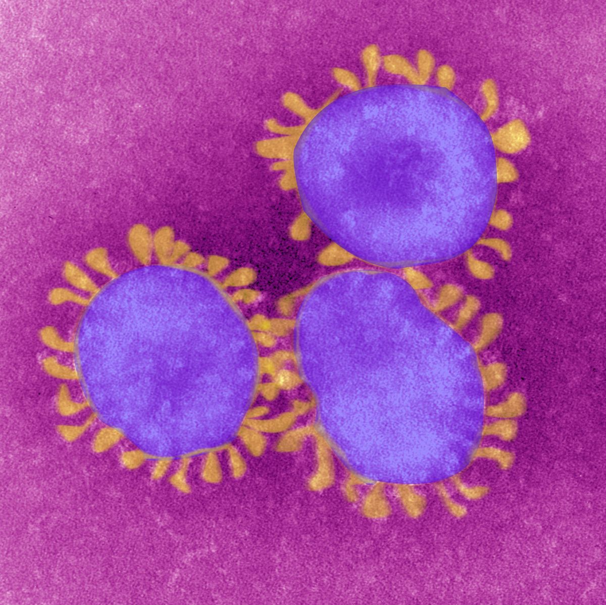 can coronavirus spread before symptoms show