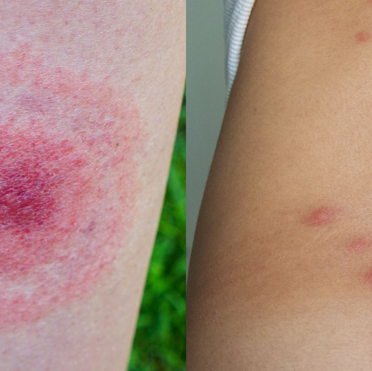 Allergy Rash On Skin Leg Caused By Bug Bites From Topical Beach Sand Stock  Photo - Download Image Now - iStock