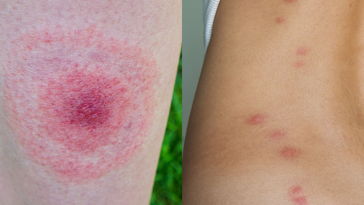 19 Common Bug Bite Pictures - How to ID Insect Bites and Stings