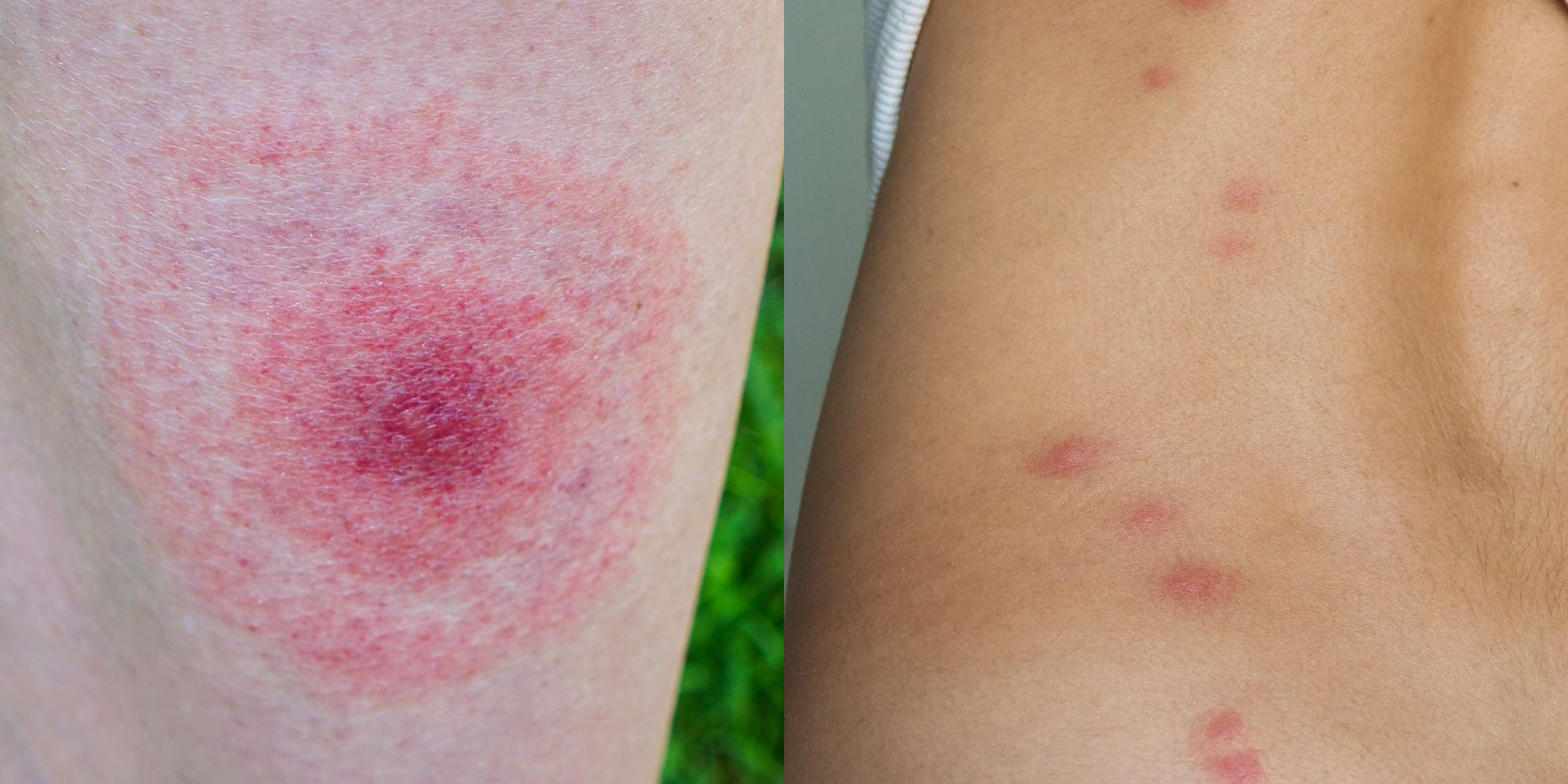 little red dots on skin bug bites