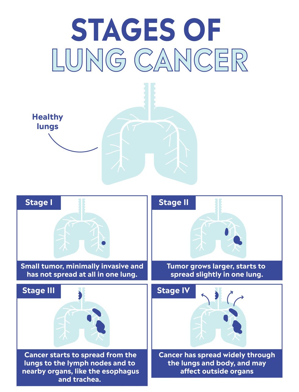 What Is Lung Cancer? Symptoms, Causes, Treatment, Prevention