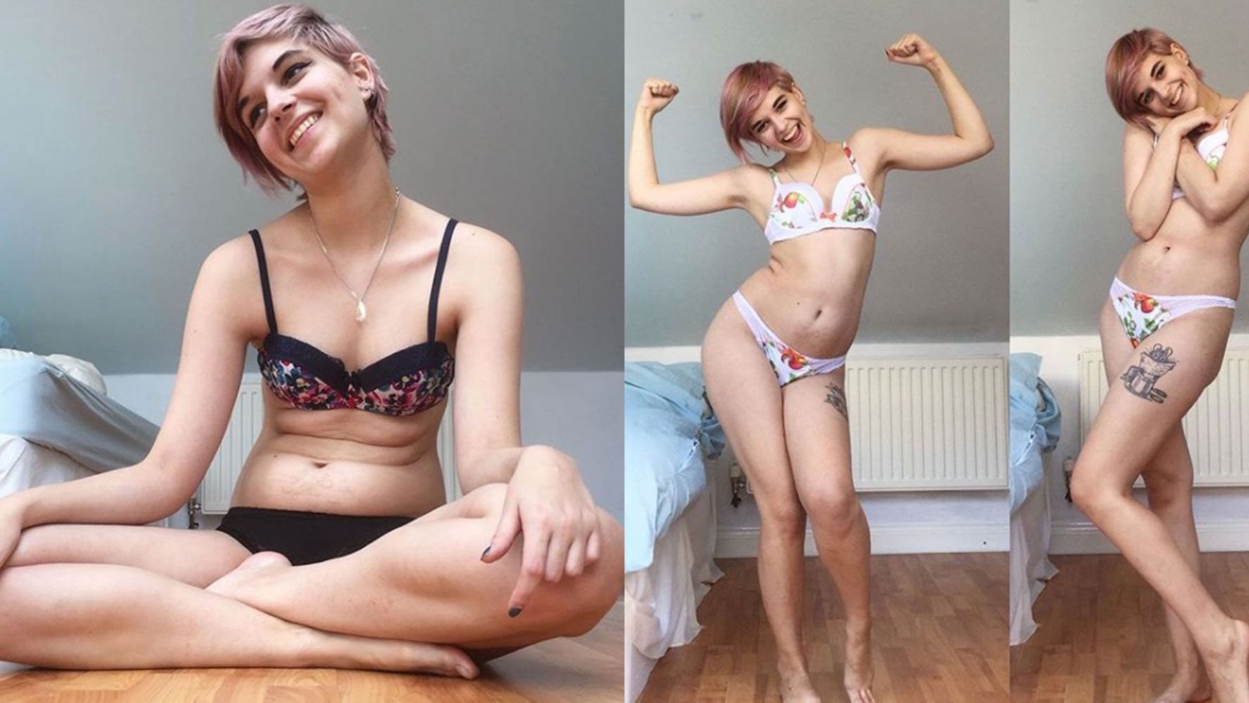anorexia before and after pictures of people with anorexia