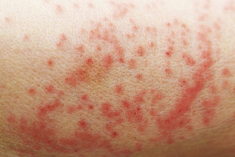 contact dermatitis