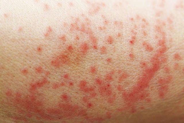 Why Do My Armpits Itch Common Causes And Treatments Of Itchy Armpits 