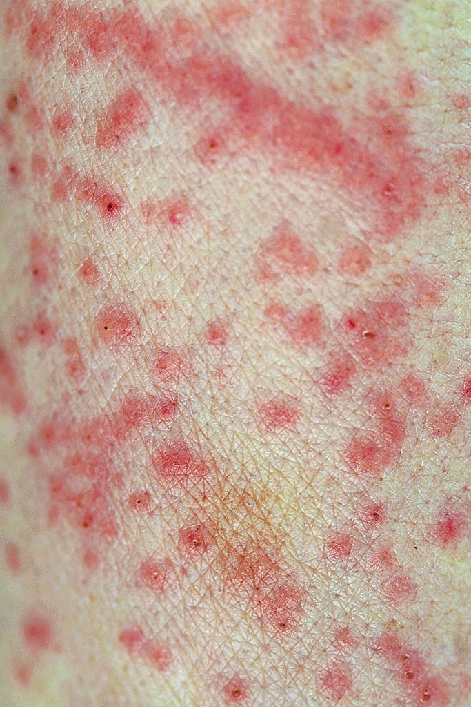 What Causes Red Spots On Skin & How To Treat Them – SkinKraft
