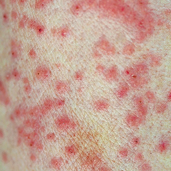 contact dermatitis skin rash