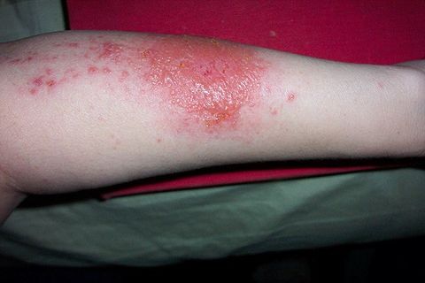 what does eczema look like   contact dermititis
