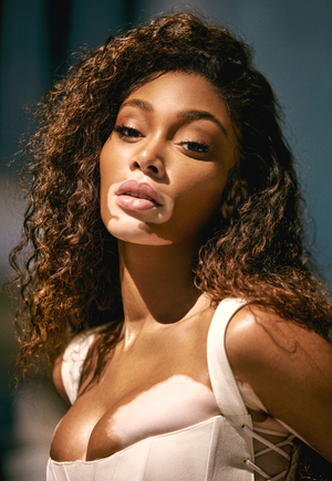 winnie harlow vitiligo