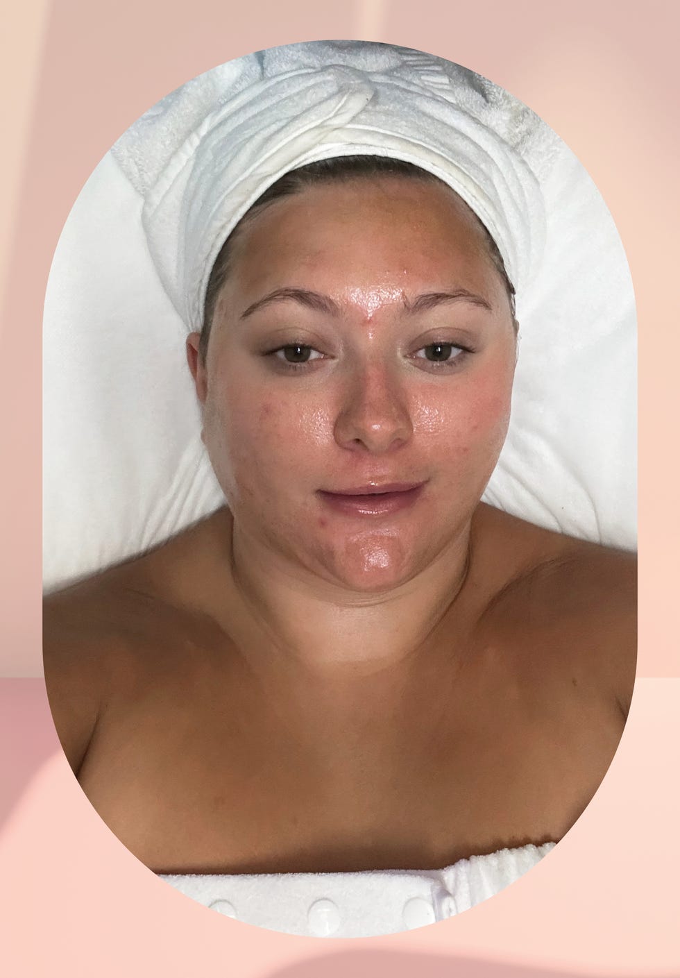 PCA skin peeling