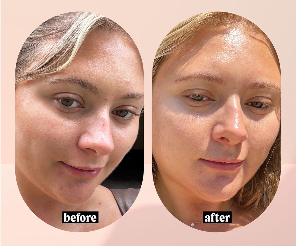 pca skin radiant and even peeling before and after