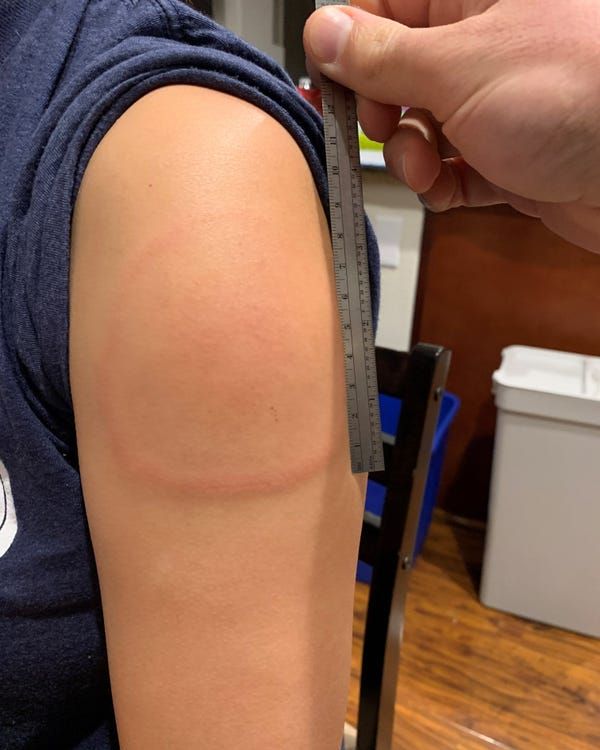 red swollen arm rash after vaccine