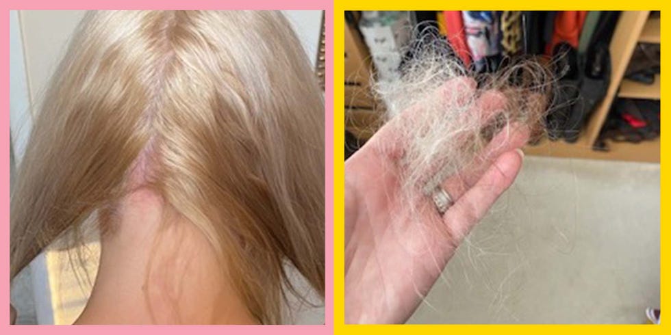 Will Washing My Hair Everyday Make It Fall Out? - Wimpole Clinic