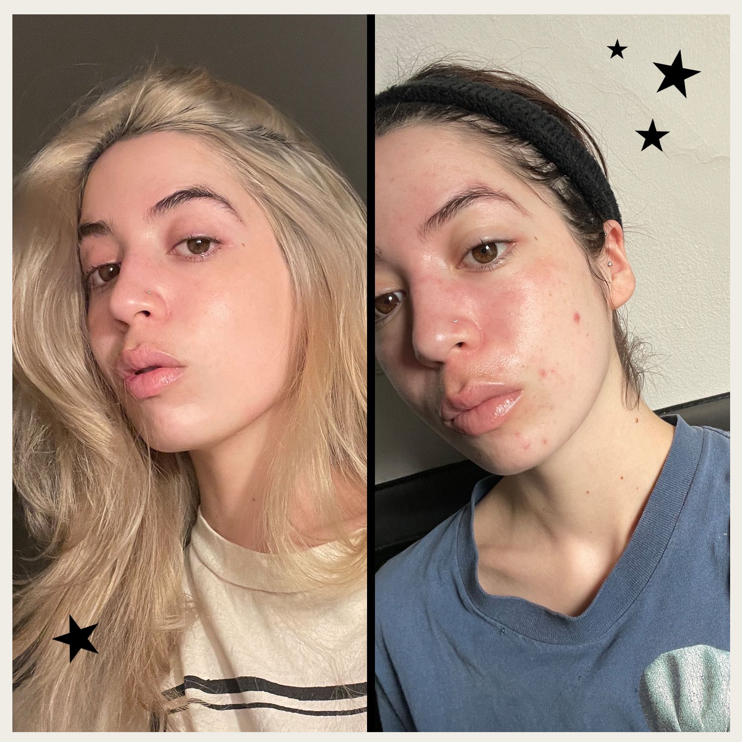 Woman's Before and After Accutane Photos Go Viral on Reddit