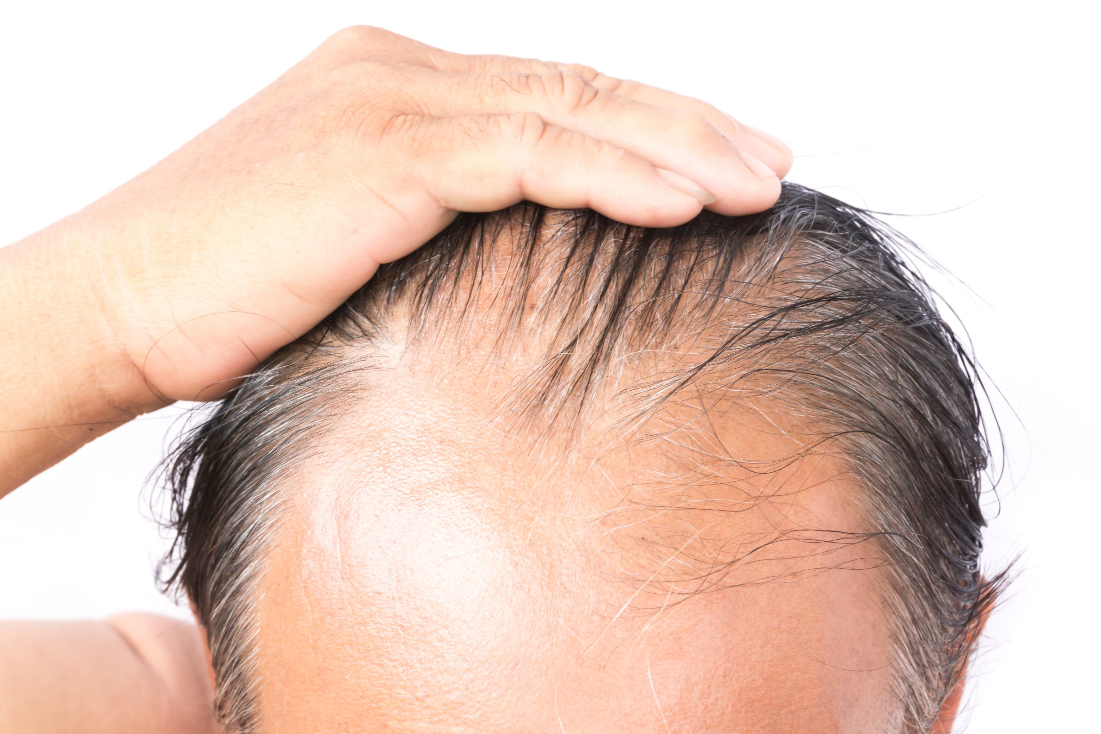 Male Hair loss  VERTEX