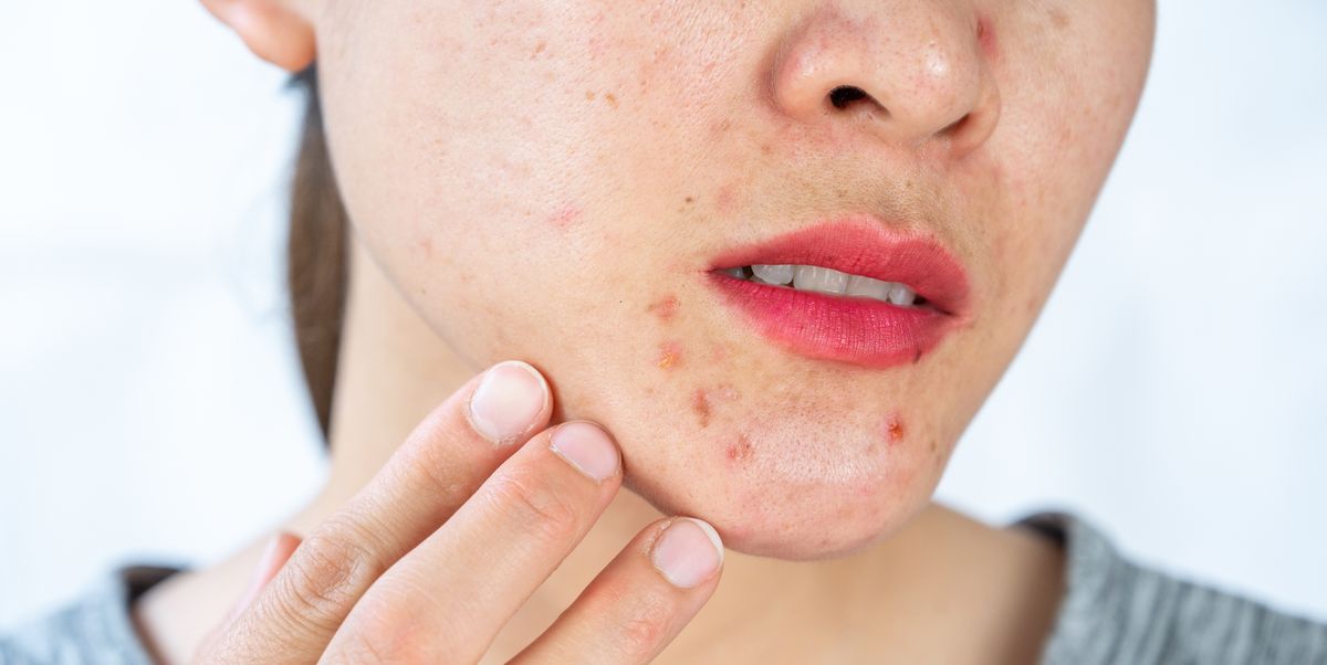 How to Get Rid of Chin Acne, According to Experts — Treat Pimples on the  Chin