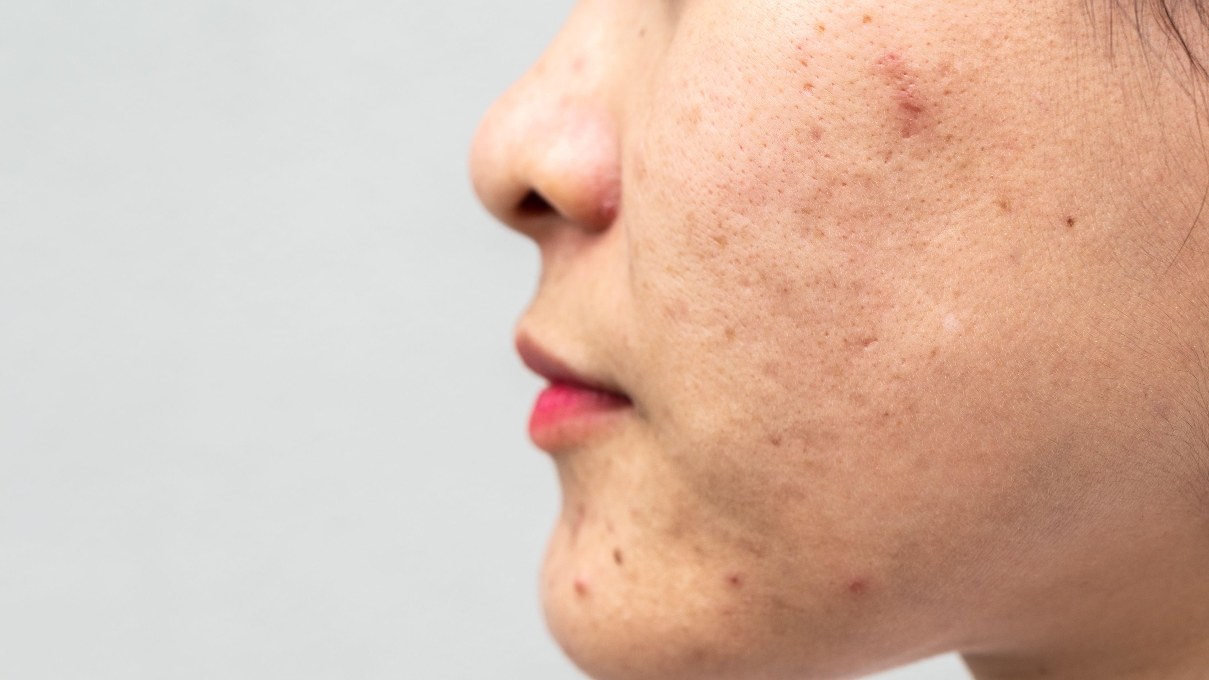How to Get Rid of Clogged Pores in 2024 - Treatment and Prevention