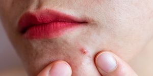 cropped shot of woman pointing to acne occur on her lower face