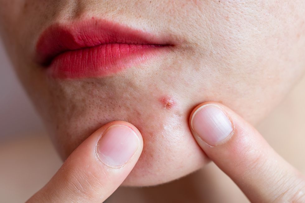 how to get rid of chin acne