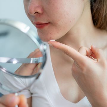 cropped shot of woman trying to applying acne cream on her skin for solving acne problem