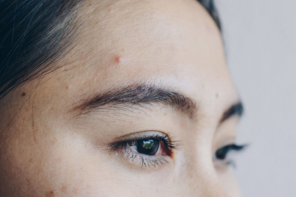 Cropped shot view of redness acne on Asian woman forehead.
