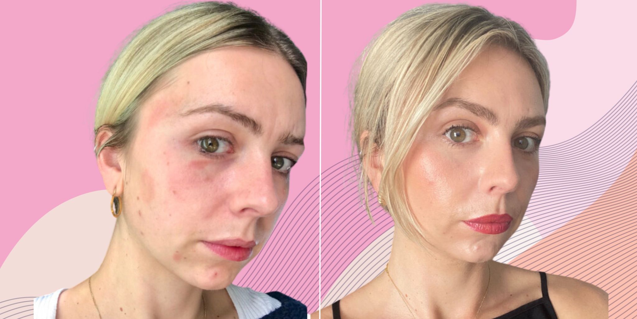 Acne prone skin, Gallery posted by Shiny