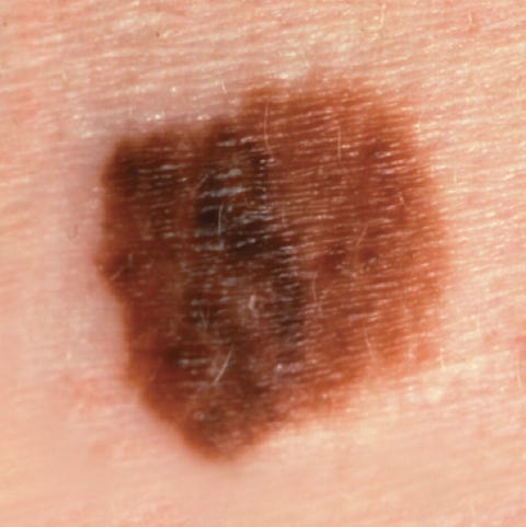 Is It Just A Mole—Or Something Worse? | Prevention