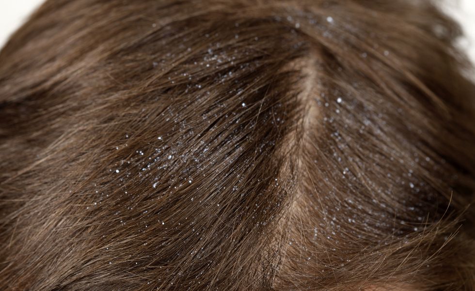 Why Is My Scalp So Itchy? - 10 Ways to Treat a Dry, Itchy Scalp