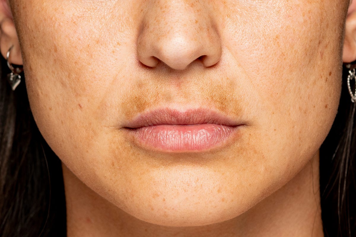 how-to-get-rid-of-a-melasma-mustache-according-to-dermatologists