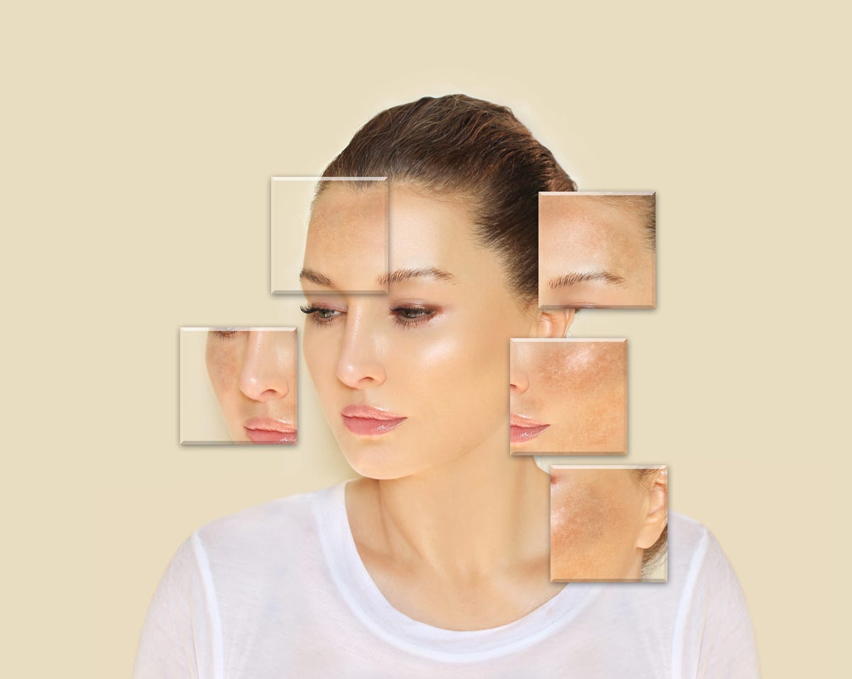 How Does Niacinamide Work to Reduce Melasma Symptoms?