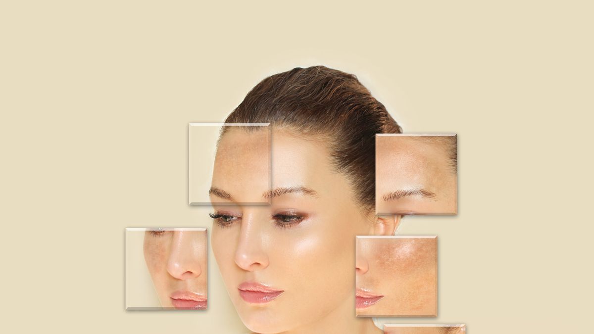 The Difference Between Melasma and Other Skin Spots