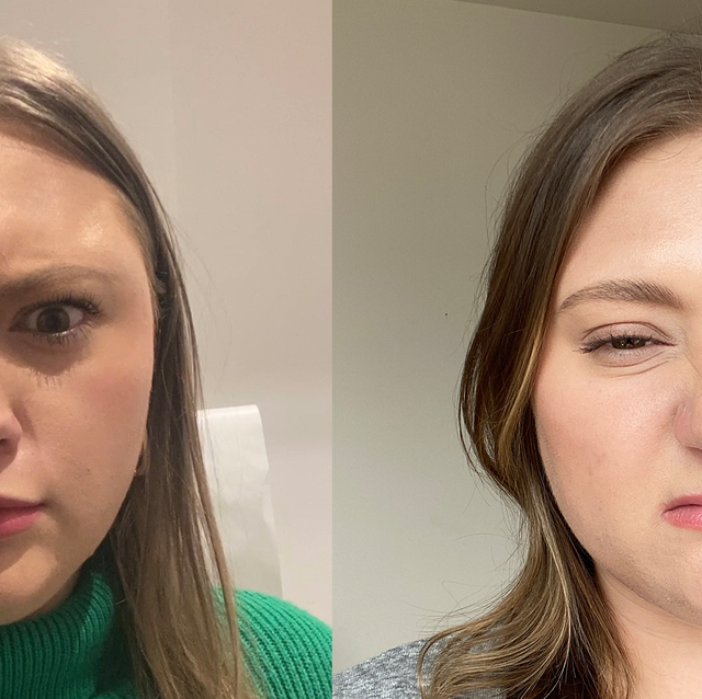What Is Daxxify 2024: I Tried the Botox Alternative Injectable
