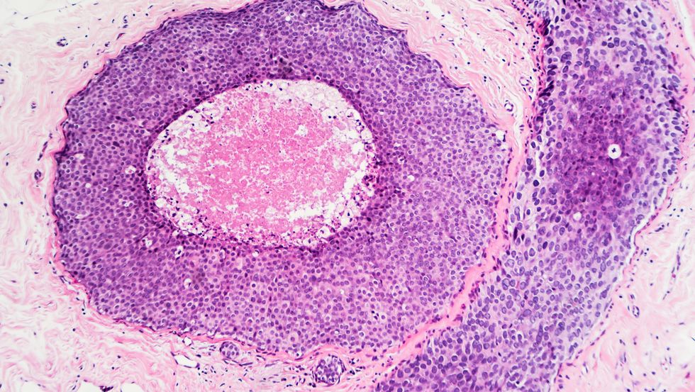 Breast Cancer: DCIS
