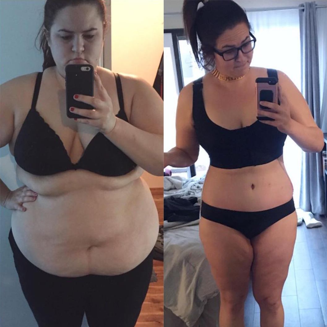 Gastric Sleeve Scars Before and After: Transformative Results