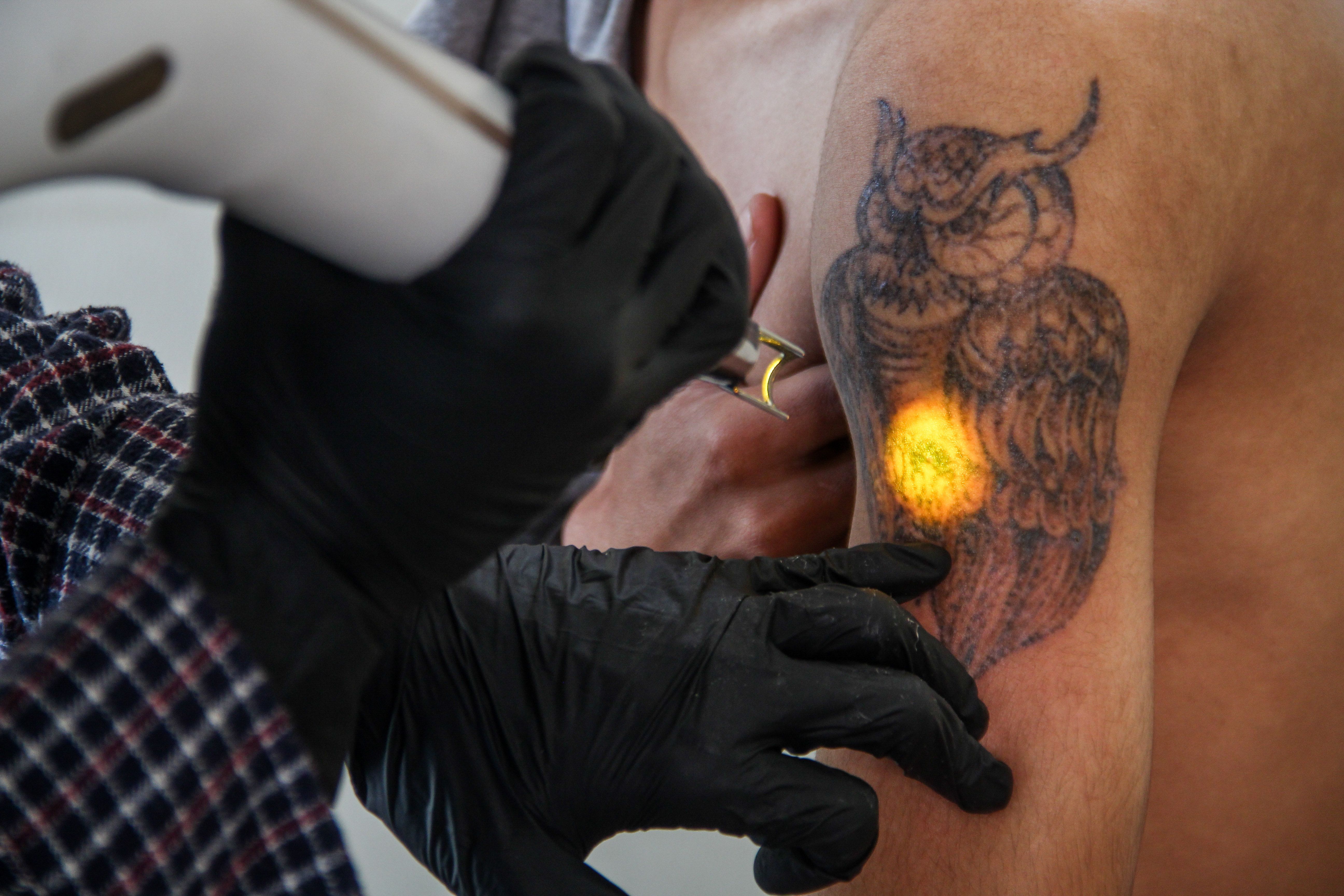 Tattoo removal: Human trafficking victims latest clients
