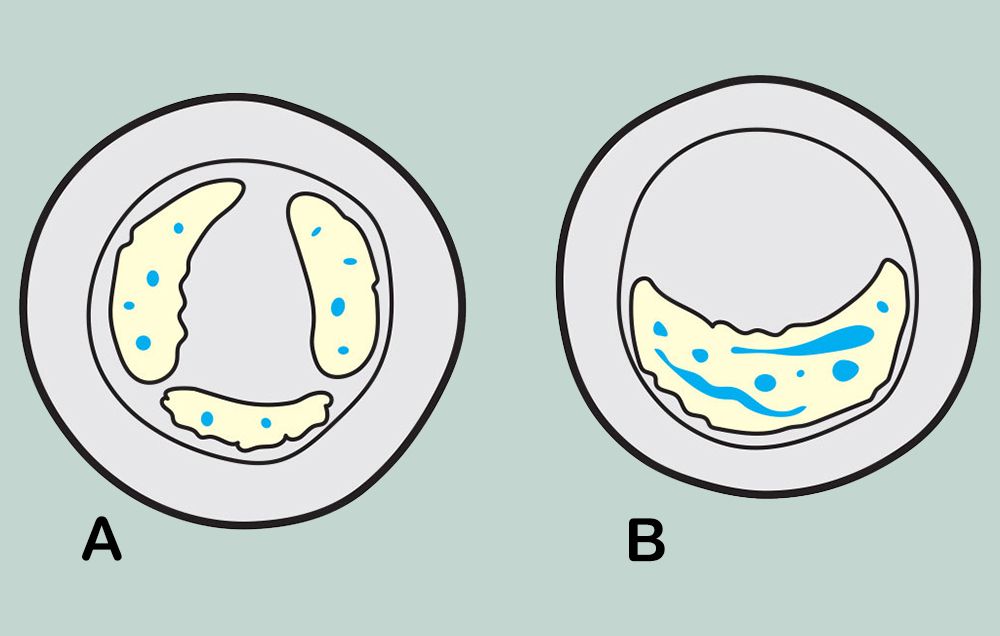 A Change of Heart denser plaques with A & B