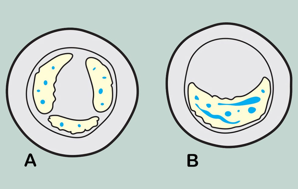 A Change of Heart denser plaques with A & B