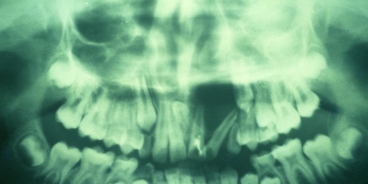 Have Sensitive Teeth? Scientists Say They May Have Evolved to Feel—Not Chew