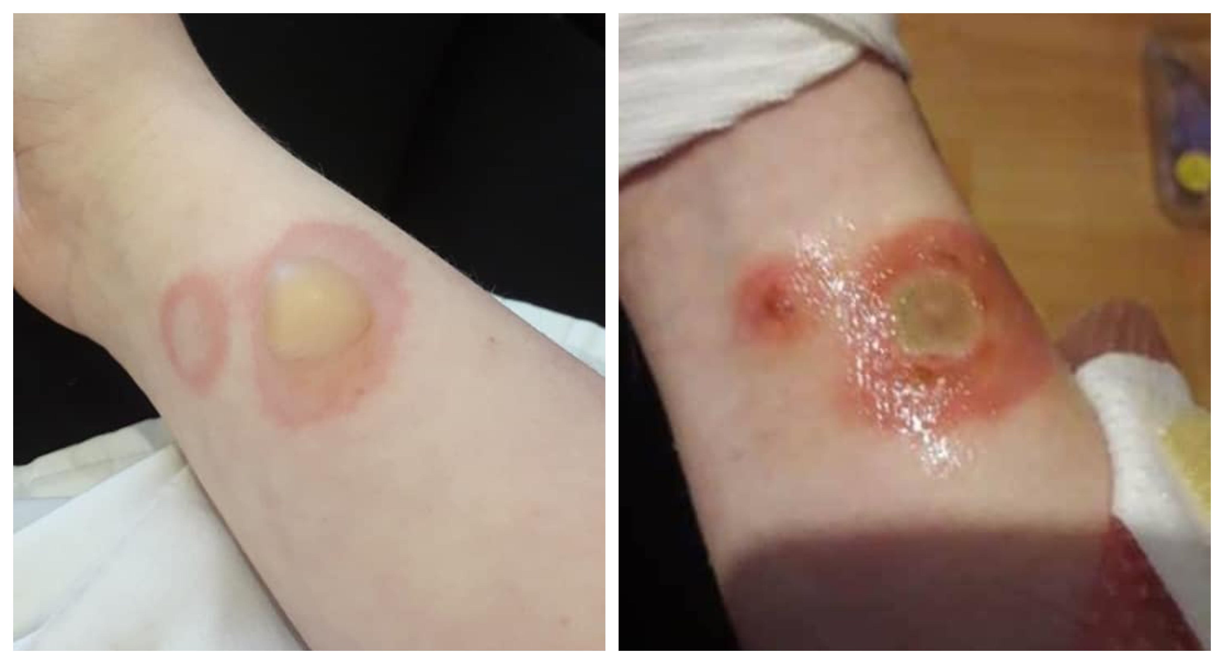 What Is the Deodorant Dangerous Teen Trend Leaves Kids With Burns