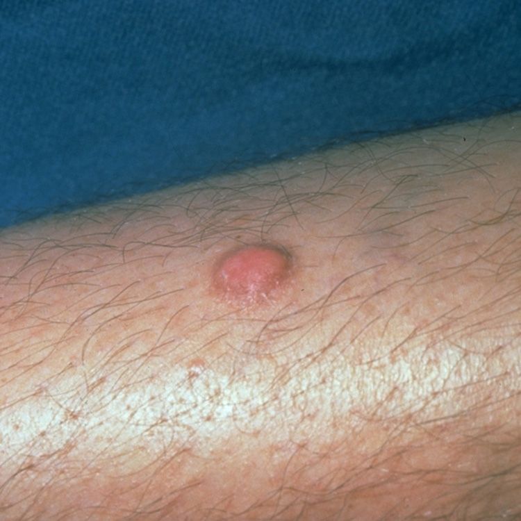skin cyst on leg