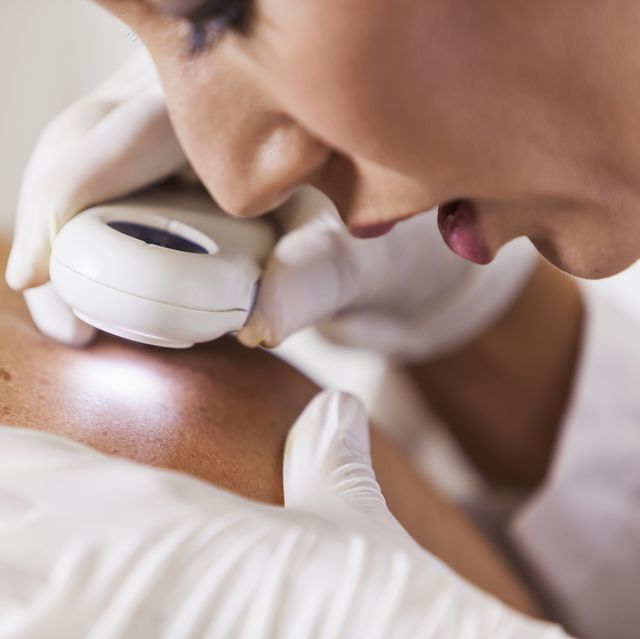 dermatologist examining patient for signs of skin cancer