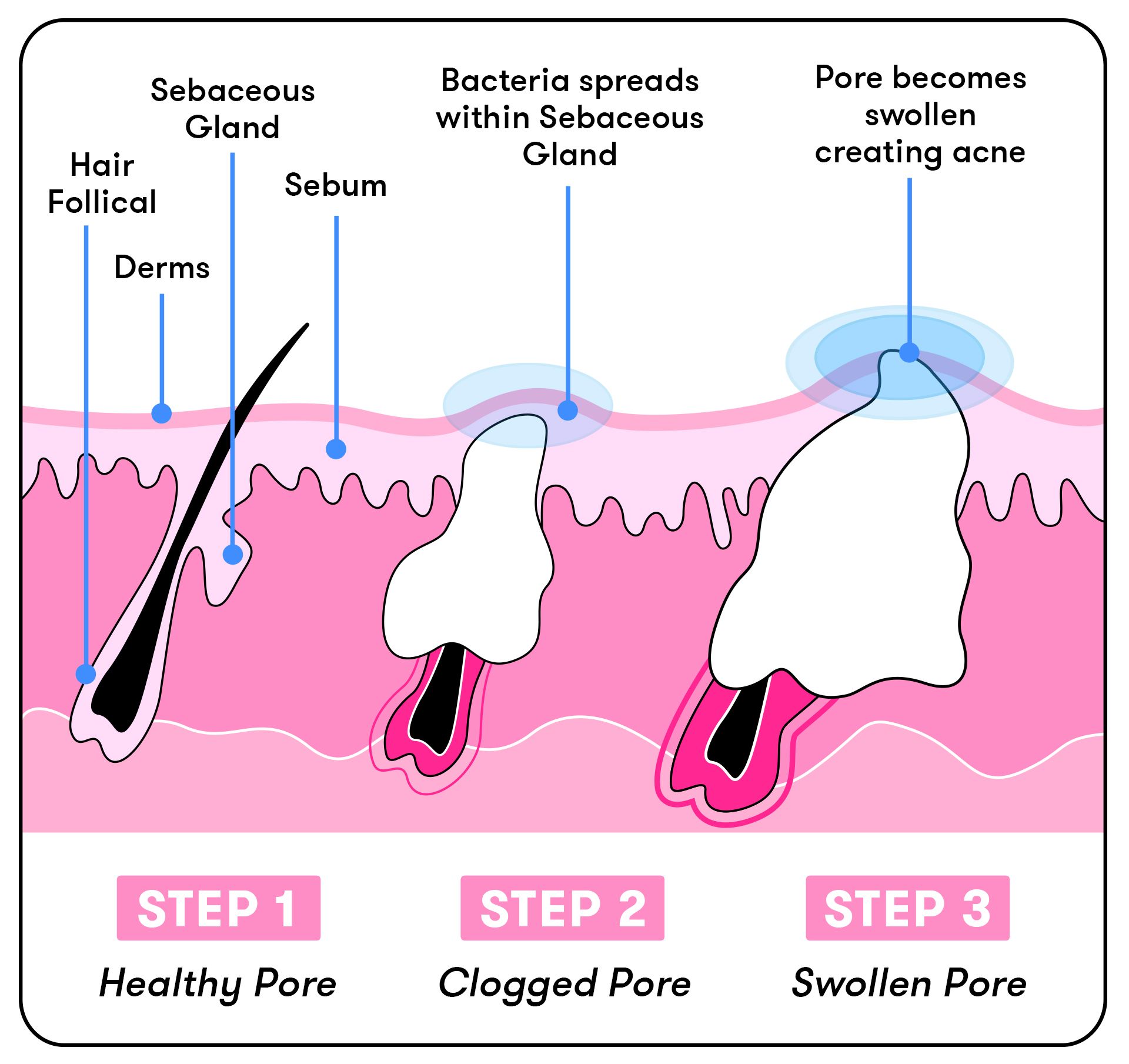 swollen pimple under skin