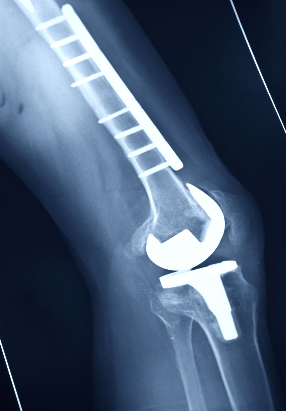 Digital x-ray following successful knee replacement surgery