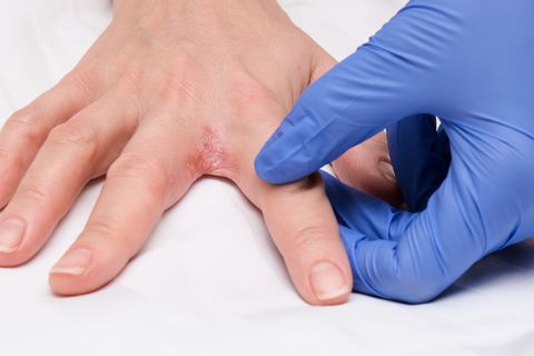 a doctor dermatologist examines patients hand with interdigital dermatitis, dyshidrotic eczema on hand