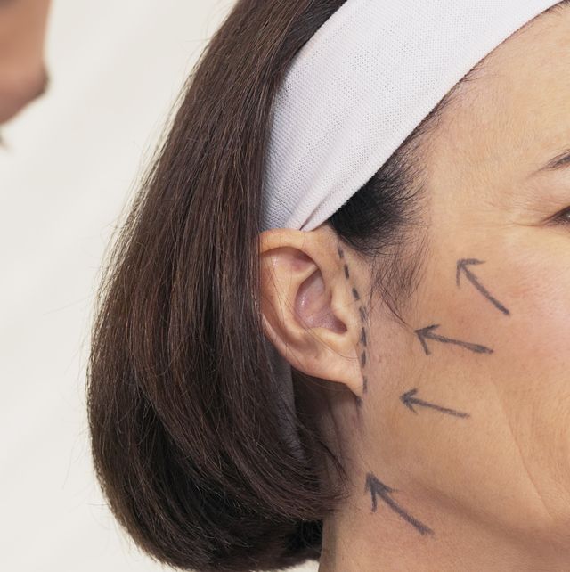 vrouw tijdens consult bij plastisch chirurg voor facelift