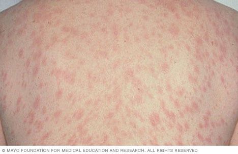 30 Common Skin Rashes Pictures Symptoms and Treatment