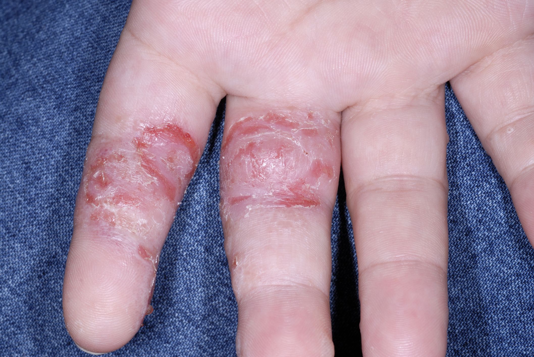 Eczema Spreading On Hands