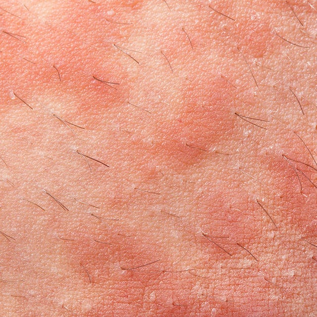 How to Treat 4 Common Rashes | Men's Health