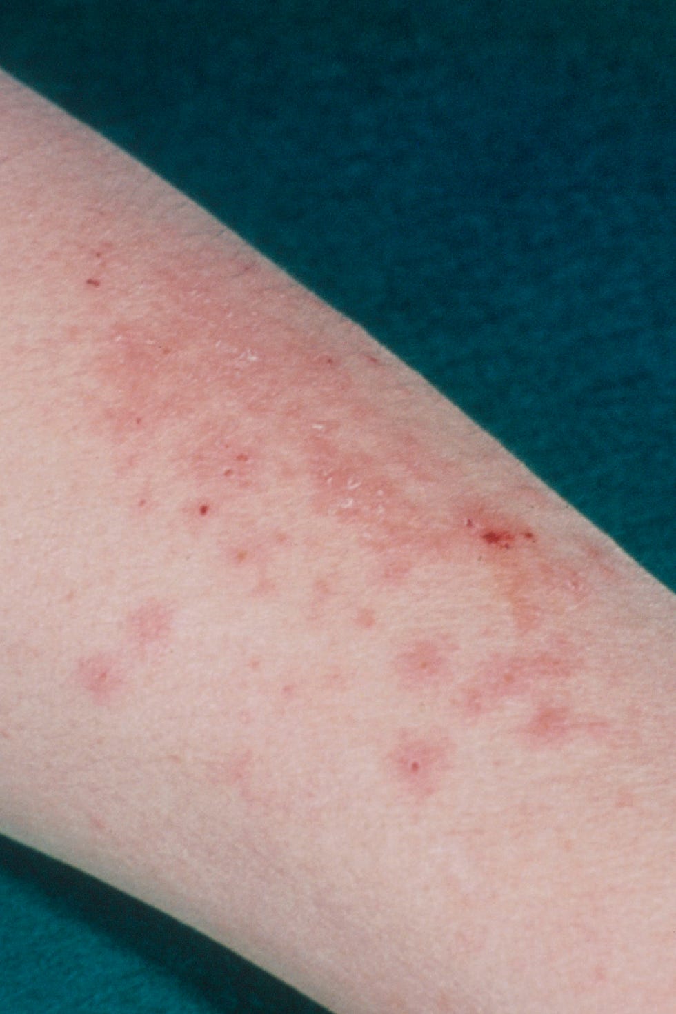 Eczema eczema